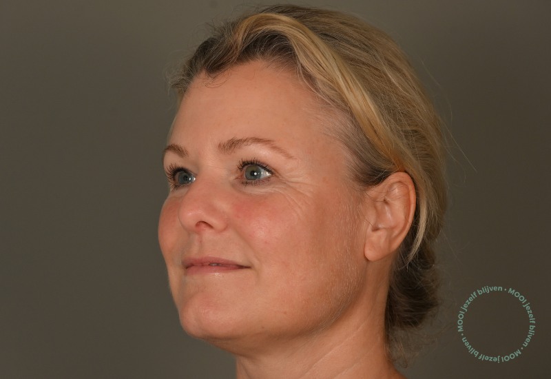 resultaat bbl heroic laser