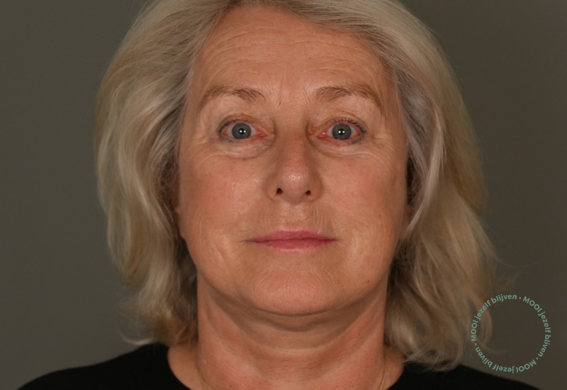 resultaat deep plane facelift foto