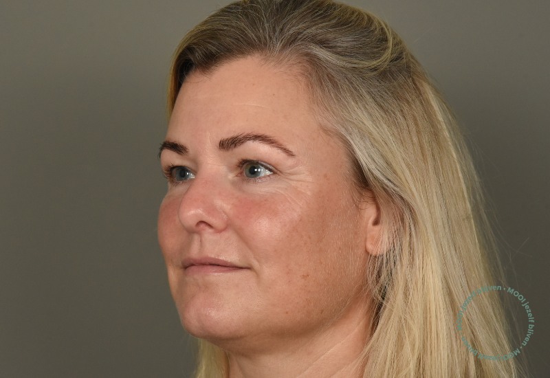 voor bbl heroic laser