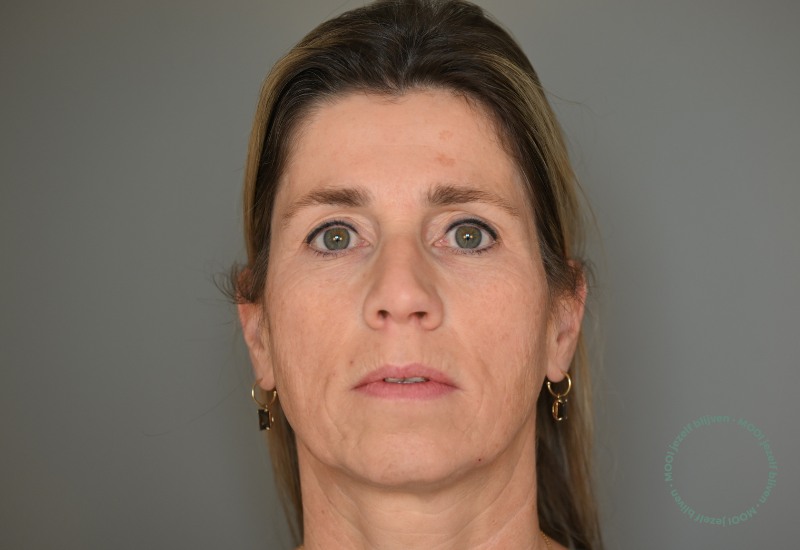 voor foto laserbehandeling