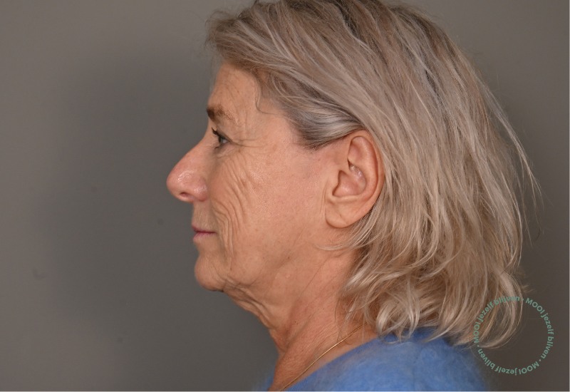 zij aanzicht deep plane facelift voor foto