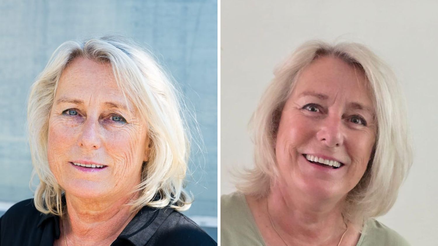 deepplane facelift ervaring