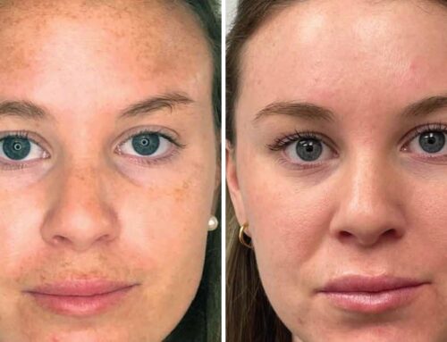 Melasma behandelen: donkere vlekken verwijderen