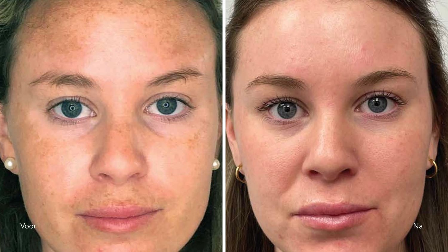 laserbehandeling melasma