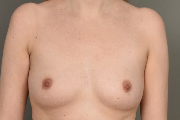 lipofilling borstvergroting cup