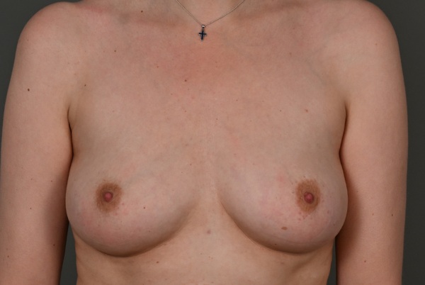 resultaat lipofilling borstvergroting