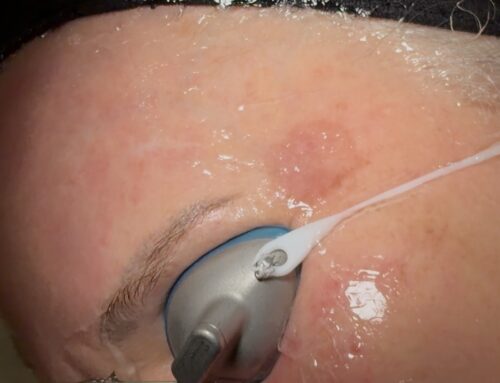 Donkere vlekken in het gezicht, dit kun je eraan doen