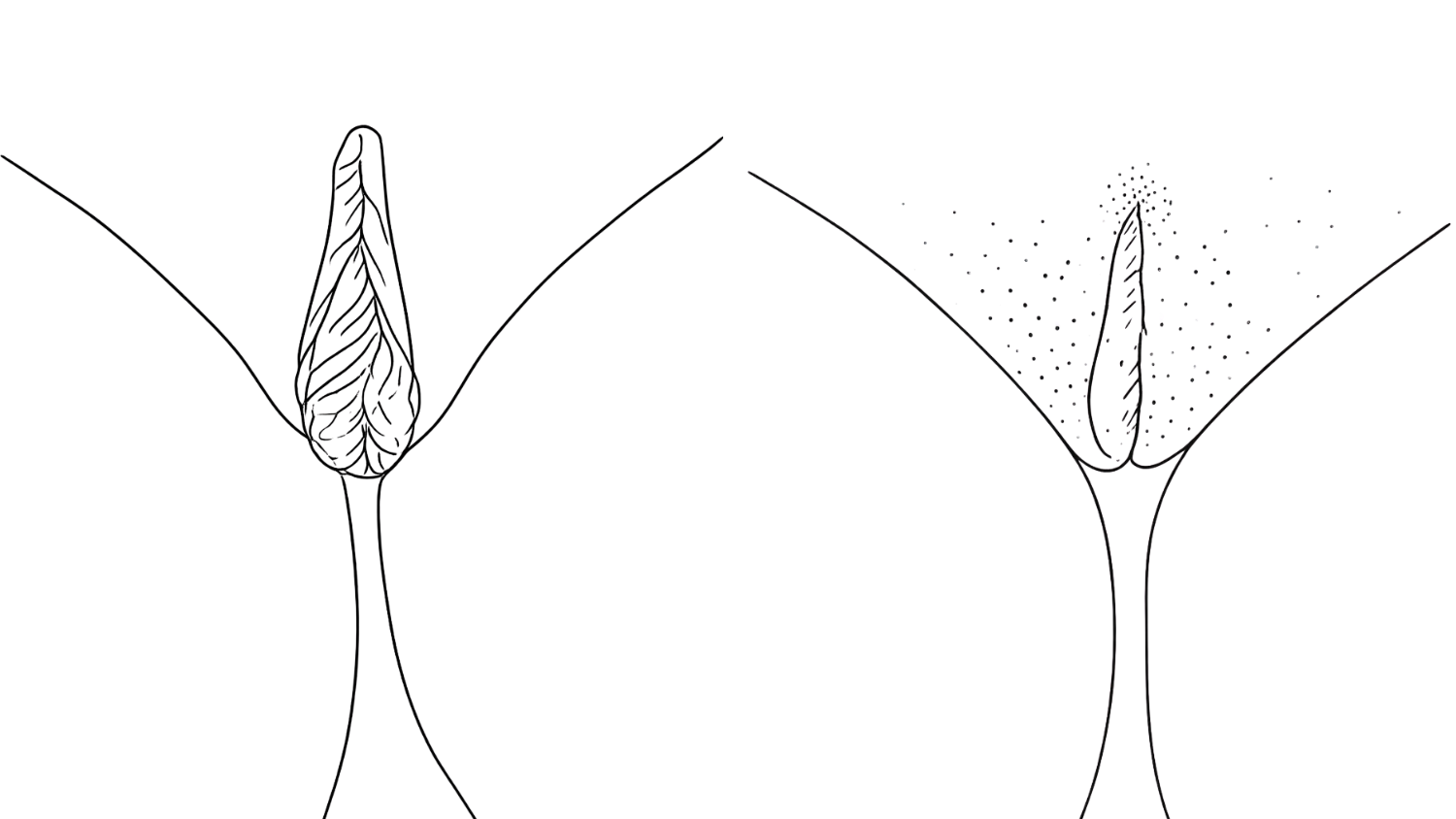 schaamlippen verkleinen ervaring en foto
