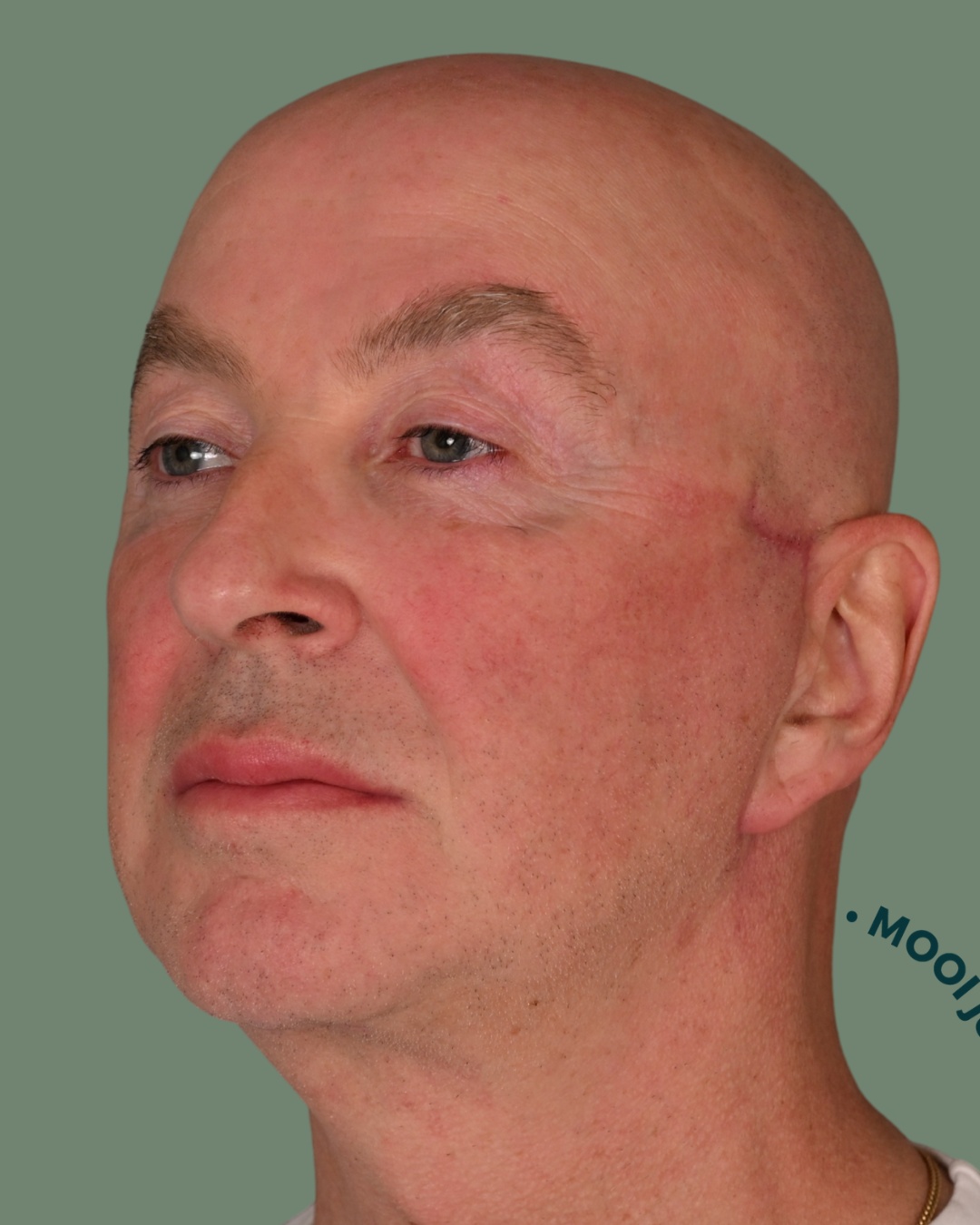 litteken facelift kale man