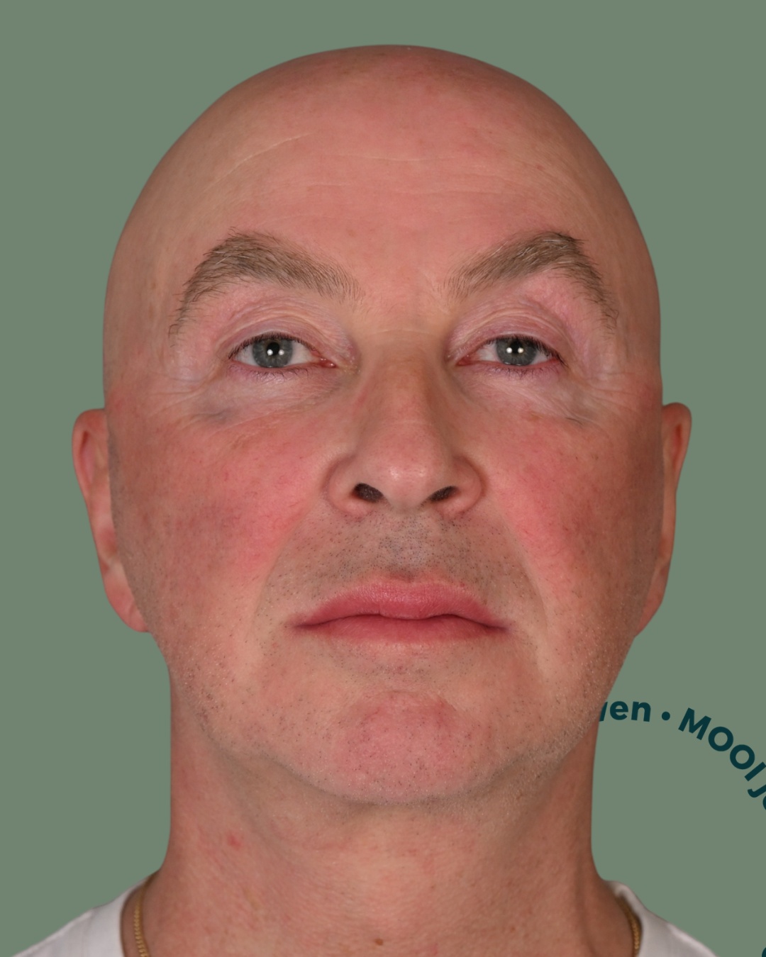 na facelift operatie