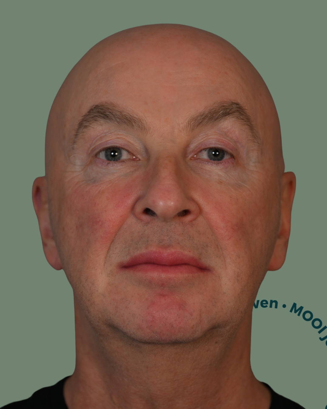 voor facelift operatie