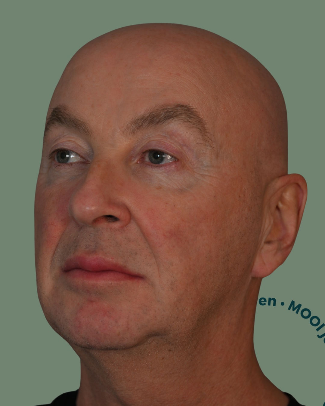 zijaanzicht facelift