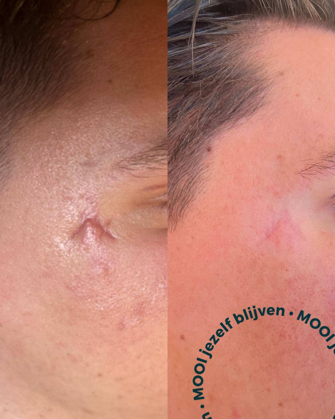littekencorrectie laser