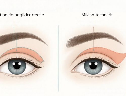 Milaan techniek bij een ooglidcorrectie: waarom wij dit bij MOOI kliniek niet doen